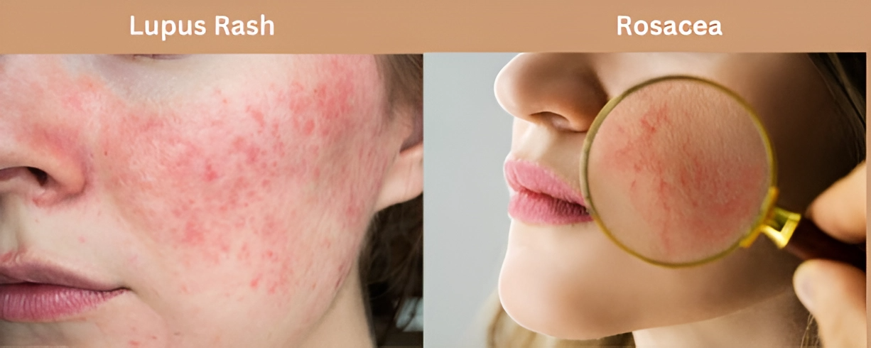 Lupus Rash vs Rosacea